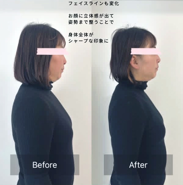 女性 横顔 ビフォーアフター